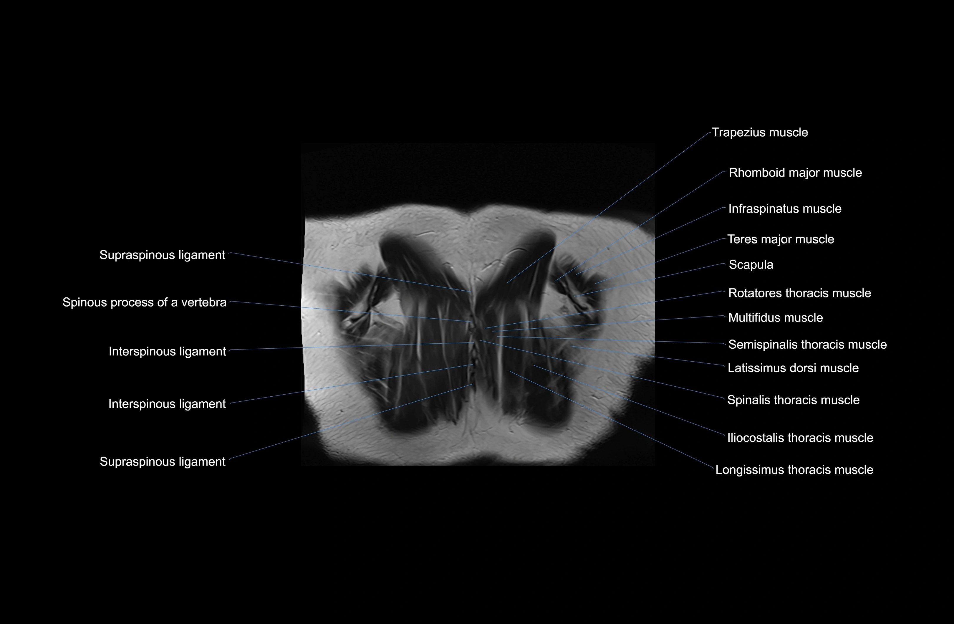 MRI chest (thorax) coronal  cross sectional anatomy 3T radiology  image-img-00001-00043.webp